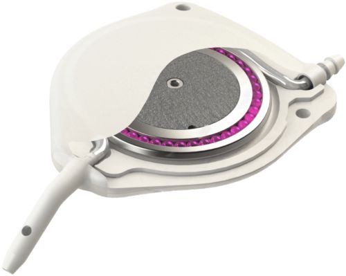 eyeWatch Glokom Drenaj mplant