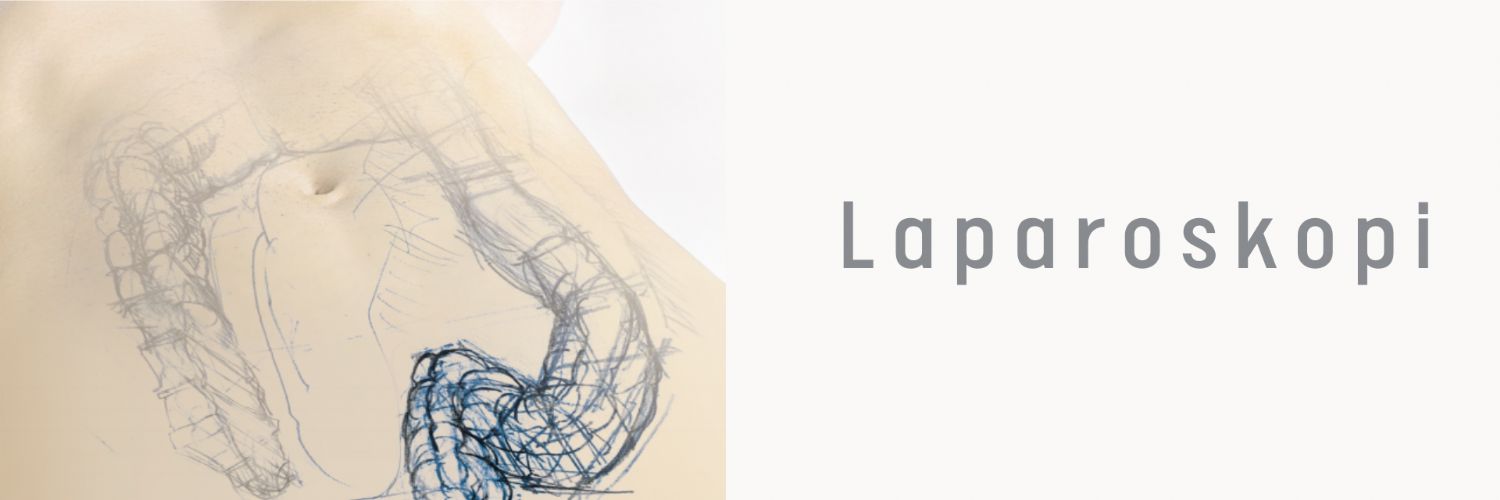 Laparoskopi 